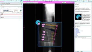 High Tibial Osteotomy HTO 2  Deformity Correction Planning  Materialise OrthoView [upl. by Anahahs122]