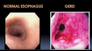 Diagnosis and Treatment for Esophageal and Motility Disorders Video  Brigham and Womens Hospital [upl. by Bertha]