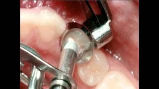 Amalgam Fillings Procedure  Lake Merritt Dental Oakland CA [upl. by Assirrec]