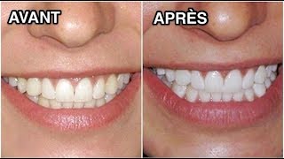 Comment Blanchir Ses Dents Naturellement  3 Recettes Pour Blanchir ses Dents EN 2 minutes [upl. by Afrika932]