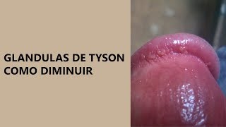 GLANDULAS DE TYSON COMO DIMINUIR  DESCUBRA COMO ACABAR LOGO DE UMA VEZ [upl. by Opaline]