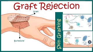 Graft rejection  Immunological basis of graft rejection [upl. by Noiroc620]