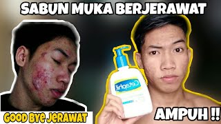 CARAKU MENYEMBUHKAN JERAWAT DENGAN CEPAT  My Skincare Routine [upl. by Akeirahs]