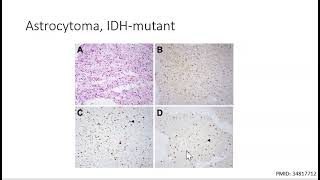 CNS Neurosurgery 100 Glioma Biology [upl. by Giffy]