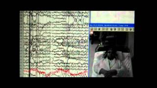 Nonepileptic seizures with levetiracetam therapy  Supplementary video 60089 [upl. by Odraleba292]