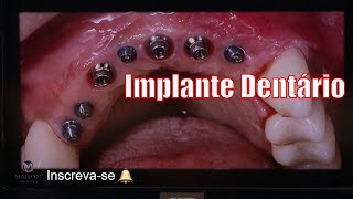 Implante Dentário Um a Um Individual [upl. by Nnyloj]