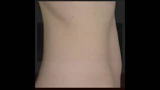 SculpSure  Real People Real Results [upl. by Nuy620]