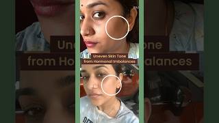 Indulekha Soap  For my uneven skin tone in just 4 weeks  Parvathy R Krishna [upl. by Adao]