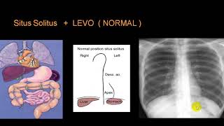 DEXTROCARDIA [upl. by Audras223]