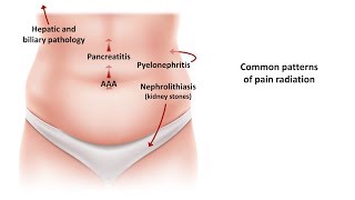 An Approach to Acute Abdominal Pain [upl. by Northrup]