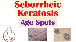 Seborrheic Keratosis “Age Spots”  Risk Factors Causes Skin Lesions Diagnosis Treatment [upl. by Mowbray641]