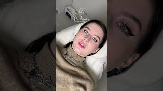 Контурная пластика губ с эффектом pushup увеличениегуб cosmeticsurgeon доктор врачкосметолог [upl. by Barret]