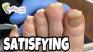 TWO INCH LONG TOENAILS TRIMMED SO SATISFYING AND SOOTHING TO WATCH [upl. by Rednijar]