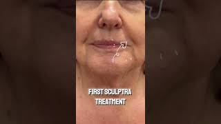 Sculptra Results with Stephanie Moore APRN at Dr Pacholec Wellness amp Weight Loss [upl. by Tat206]