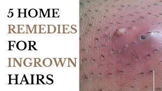 5 Home Remedies For Ingrown Hairs [upl. by Rene726]