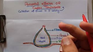 Pericardial Effusions or cardiac tamponade cause aspirationdrainage techniques [upl. by Ahsienor]