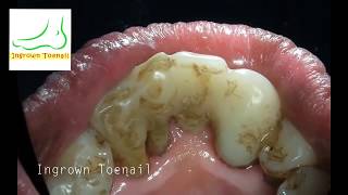 Extreme dentist teeth scale cleaning [upl. by Ramel]