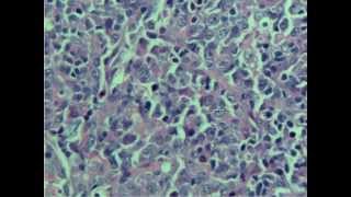 Diffuse large Bcell lymphoma [upl. by Retlaw25]