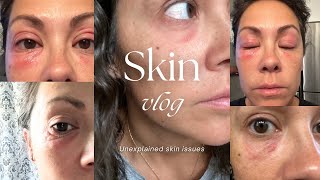 Skin Vlog  Unexplained Under Eye Issues [upl. by Eliak]