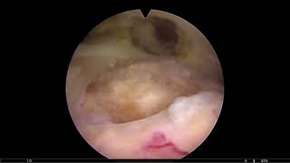 Schulterarthroskopie mit einfacher Rotatorenmanschettennaht [upl. by Lussier346]