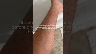 Show a picture of my legs before and after Rxmoore IPL hair removal hairremover beautycare [upl. by Leisha]