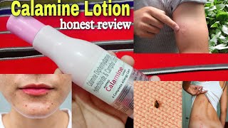 Calamine Lotion Benefits amp Uses  Dephenhydramide HCL Camphor  Austro Calamine Lotion [upl. by Negroj159]