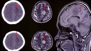 Subdural Hematoma SDH  Diagnosis management Burr hole surgery or craniotomy [upl. by Sondra]