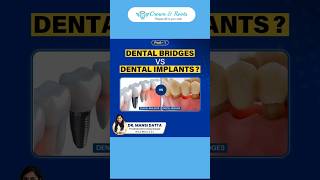 Dental Bridge VS Dental Implant  Part 1 [upl. by Brent]