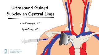 Ultrasound Guided Subclavian Central Lines  BAVLS [upl. by Conlon]