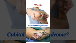 Cubital tunnel syndrome Ulnar neuropathy at the elbow shorts osborneband [upl. by Ttennej]