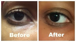 How I corrected my saggy hooded eyelid without surgery [upl. by Sipple186]