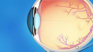 What is glaucoma [upl. by Noreg755]