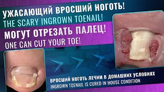 Ужасающий вросший ноготь  The scary ingrown toenail Динамика динамика instagram health nails [upl. by Leora]