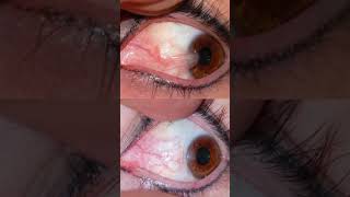 Pterygium  Sivam clinic GV eye care ophthalmologist [upl. by Ahrendt]