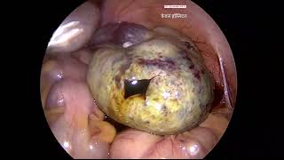 Ovarian Torsion by Dr Gajanan Patil  Kewal Hospital  Laparoscopy Training [upl. by Harutak]