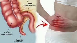 APENDIKSIZORRA QORRE apendix shendeti inflamacionet kirurgjia mjekesi medicina apendektomia [upl. by Adnomar]