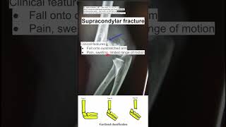 Supracondylar fracture [upl. by Notsek]