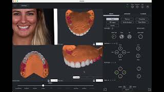 SmileFy 40  AUTOMATED AI 3D Smile Design Demonstration realtime [upl. by Ezzo]