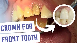 Dental Crown Front Tooth Steps Explained [upl. by Vassili]