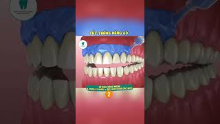 😮 nhatrang nhatrangdental nhakhoaopal taytrangrang dentist [upl. by Lenehc]