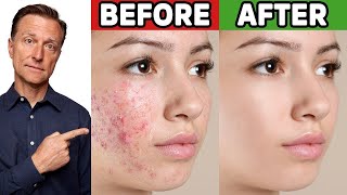 The Best Trick for Clear Skin Acne Aging Wrinkles Liver Spots [upl. by Anisah]