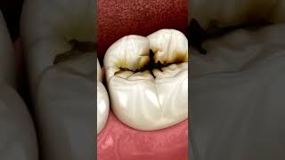 Molar tooth damage by caries [upl. by Gilburt]