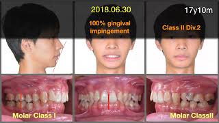 Management of ankylosed molars｜【Chris Chang Ortho】CC566 [upl. by Hsakaa]