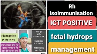 RH negative प्रेगनेंसी में ICT पॉजिटिव है ।अब क्या करें RH Isoimmunization amp fetal hydrops [upl. by Yerg]