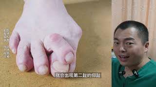 hallux valgus 拇外翻的发展进程，仰趾锤状趾畸形 [upl. by Shuman375]