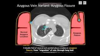 Chest Radiology The Azygous Fissure a normal variant [upl. by Reahard569]