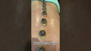 A combination techniques with Moxibustion amp Dry Needling dryneedling moxibustion [upl. by Weintrob]