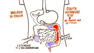 Maladie Inflammatoire de Lintestin MII [upl. by Ilajna]