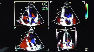 3D farbkodierte DopplerDarstellung  3D with doppler imaging [upl. by Adamok]