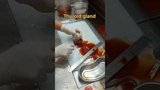 Cystic thyroid gland gross pathology [upl. by Jacki840]